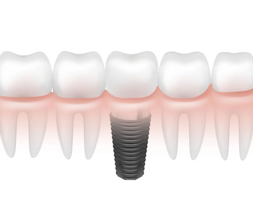 How Painful are Dental Implants