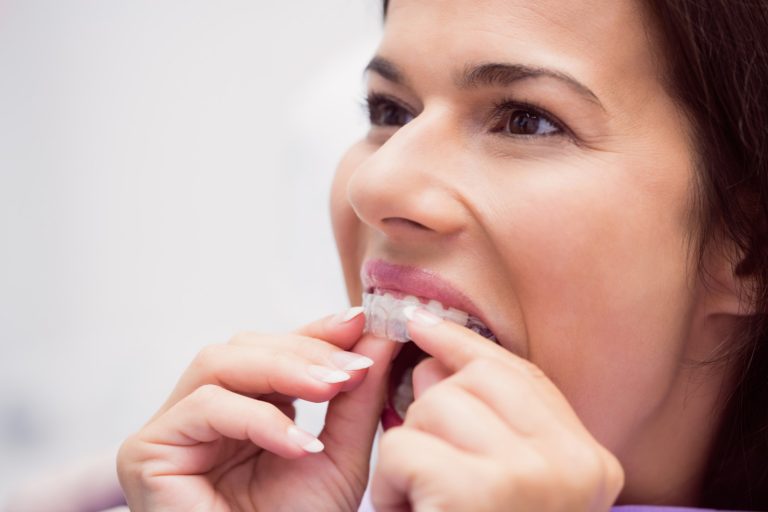 Benefits of Invisalign