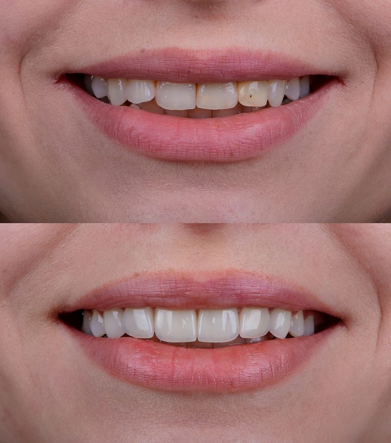 veneers Spokane WA