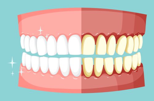 What causes yellow teeth