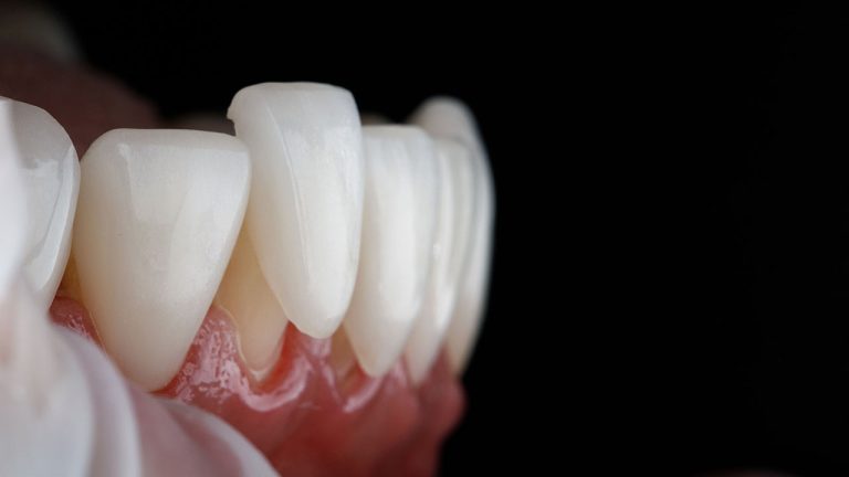 Veneers Dentist in Spokane